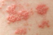 Biological therapies for inflammatory arthritis have been linked to an increased risk of herpes zoster.