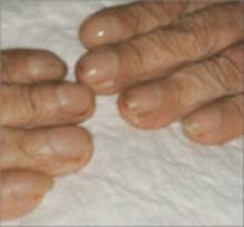 Nail Disorders And Systemic Disease What The Nails Tell Us Mdedge Family Medicine