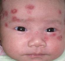 Annular rash on a newborn | MDedge Family Medicine