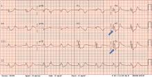 On 12-lead electrocardiography, elevation of the J point (Osborn wave; arrows) is typically seen in precordial leads V3 to V6 and is a marker for hypothermia. 