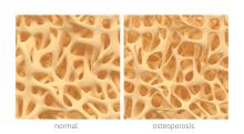 Osteoporosis