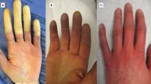 (A) White digits with intense vasoconstriction in Raynaud phenomenon; (B) blue digits with hypoxemic venous stasis; (C) red digits with hyperemic reperfusion.