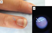 (A) Dilated nailfold capillaries in a patient with scleroderma (blue arrow); (B) dilation and dropout of nailfold capillaries (white arrow) viewed with a magnifier.