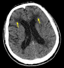 Figure 1. Computed tomography of the brain without contrast showed patchy confluent areas of low attenuation in both cerebral hemispheres (arrows).