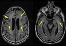 Figure 2. Magnetic resonance imaging with axial T2 fluid-attenuated inversion recovery showed confluent and symmetric white matter hyperintensities in the frontoparietotemporal region (arrows).