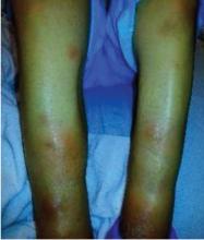 Figure 1. The patient had multiple raised erythematous nodules on the lower extremities consistent with panniculitis.