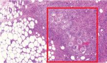 Figure 2. Biopsy study revealed pancreatic panniculitis. The subcutis showed mixed inflammation with characteristic “ghost adipocytes” of adipocyte necrosis (red box) (hematoxylin and eosin, × 10).