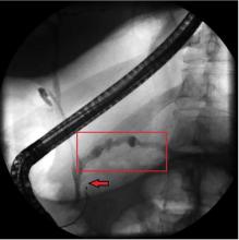 Figure 3. Endoscopic retrograde cholangiopancreatography confirmed pancreatic stricture (arrow) and dilation of the pancreatic duct (box).