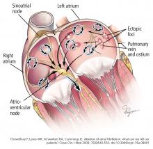 Atrial fibrillation is currently thought to arise from focal triggers