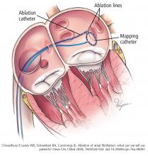 Radiofrequency ablation of atrial fibrillation