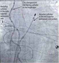 Fluoroscopic view of radiofrequency ablation