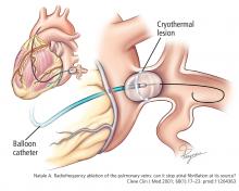 A balloon catheter lodged in the ostium of one of the pulmonary veins