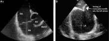 Intracardiac echocardiographic images