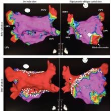 Three-dimensional voltage mapping of the left atrium