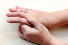 Hands with osteoarthritis