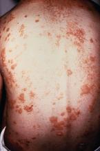 Psoriasis on a patient's back