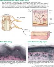 Figure 1. Small fiber neuropathy affects sensory nerves