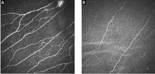 Figure 2. Corneal confocal microscopy in small fiber neuropathy.