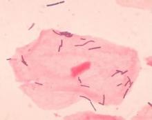 Lactobacillus - CDC 1048  Lactobacillus organisms and vaginal squamous epithelial cell.  Bacteria appeared as gram-positive rods among squamous epithelial cells and neutrophils in this vaginal smear.