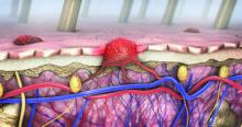 3d illustration of a cross-section of skin with melanoma that enters the bloodstream and lymphatic tract.