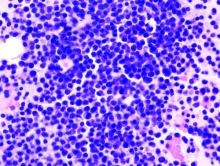 Multiple myeloma