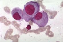 Multiple myeloma