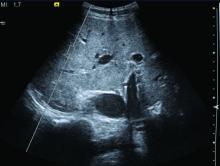 NAFLD is readily detectable in psoriasis patients on ultrasonography as exemplified by this sonogram of a patient recently evaluated by Dr. Belinato