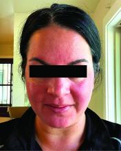 Persistent erythema in a patient with rosacea.