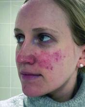 A woman with papulopustular rosacea