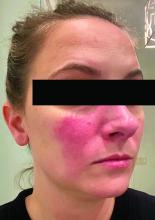 Persistent erythema in a woman with rosacea