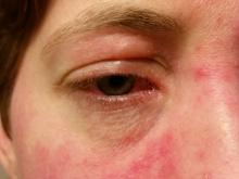 An individual with ocular rosacea.