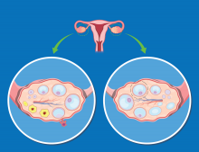 Illustration of polycystic ovary syndrome