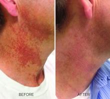 A patient with poikiloderma before and after treatment.