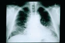 Chest x-ray