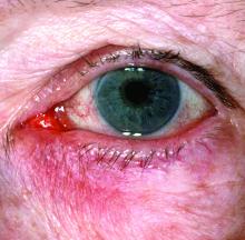 Rosacea, subtype 4: Eye irritation (ocular rosacea). Watery or bloodshot appearance, irritation, burning, or stinging.