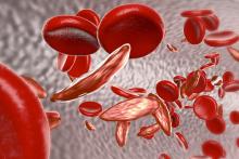 A cluster of sickle cell anemia blood cells.