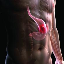 Illustration of cancer in the stomach
