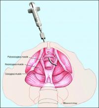Transvaginal trigger point injections can serve as a helpful adjunct to pelvic floor physical therapy.