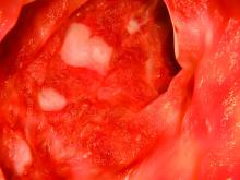 ulcerative colitis