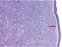 Figure 2. Punch biopsy showed diffuse atypical cellular infiltrate in the dermis, with a grenz zone of uninvolved papillary dermis.