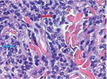 Figure 3. The tumor cells were large, with ample, vacuolated cytoplasm, large blastic nuclei with irregular nuclear membranes, and abundant mitotic figures.