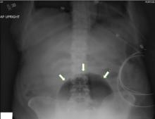 Figure 1. Plain abdominal radiography showed bladder distention with gas.