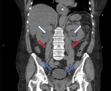 Figure 2. Coronal CT of the abdomen and pelvis revealed a diffuse collection of gas within the bladder wall (blue arrows), bilateral hydronephrosis (white arrows), and bilateral hydroureter (red arrows).