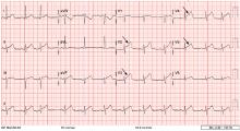 A 12-lead electrocardiogram showed ST-segment elevation of more than 2 mm in leads V2, V3, V4, and V5 (arrows), with no reciprocal changes.