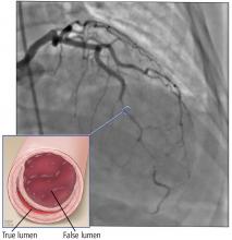 Coronary angiography before treatment 