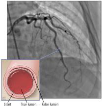 After stenting, the vessel regained normal flow. 