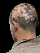 Alopecia