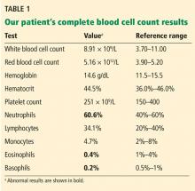 Table 1. Our patient's complete blood cell count results