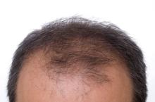 Frontoparietal baldness