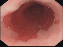 Barrett's Esophagus: The red tissue is Barrett's mucosa and the white lining is normal, squamous mucosa.